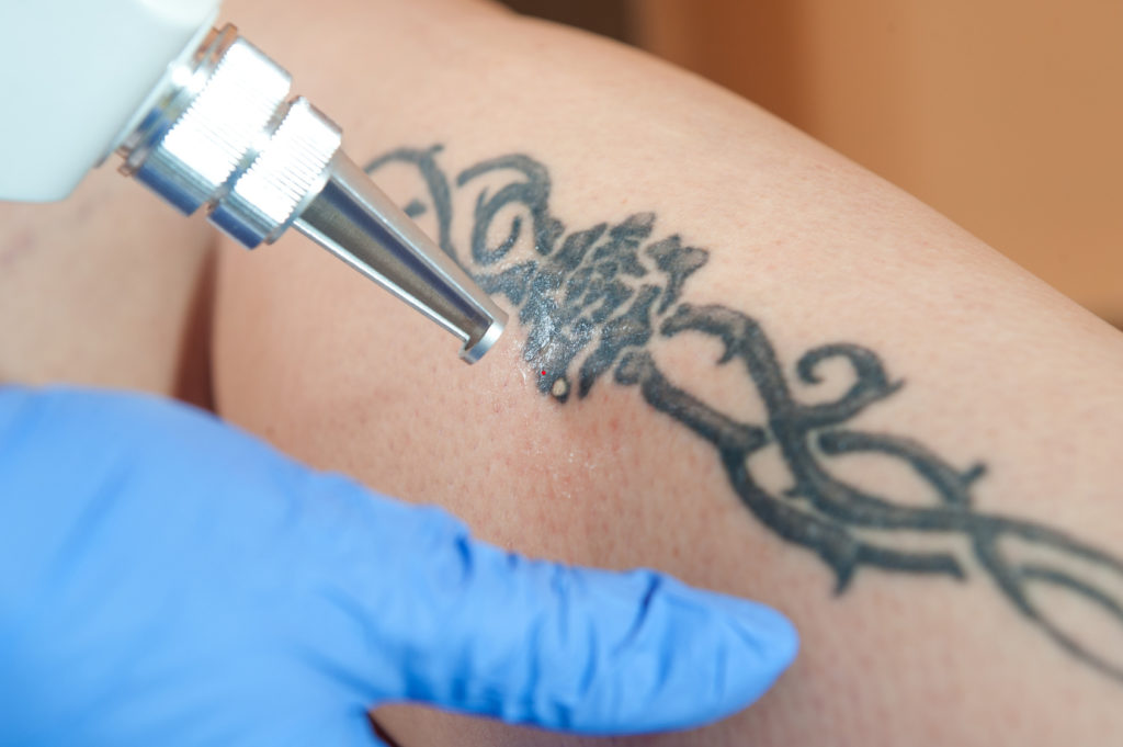 Comment fonctionne l’enlèvement de tatouage au laser ?