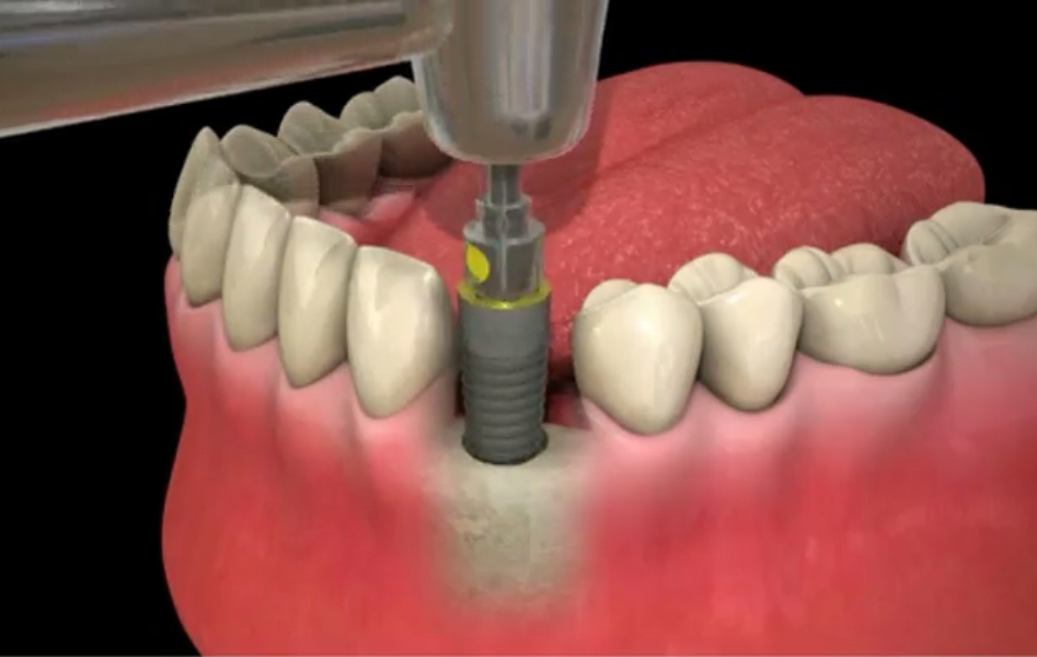 L’implant dentaire pour retrouver un confort de vie