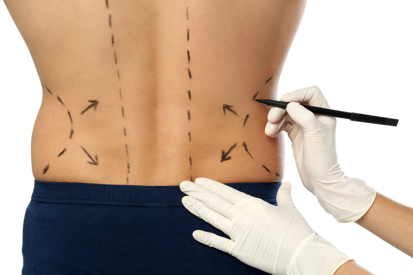 Liposuccion : 5 raisons de sauter le pas